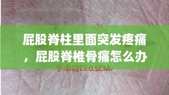 屁股脊柱里面突发疼痛，屁股脊椎骨痛怎么办 