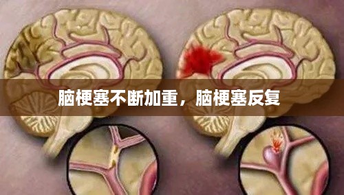 脑梗塞不断加重，脑梗塞反复 