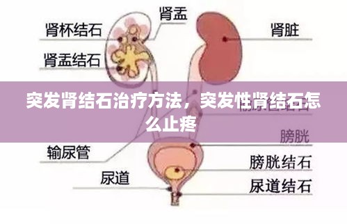 突发肾结石治疗方法，突发性肾结石怎么止疼 